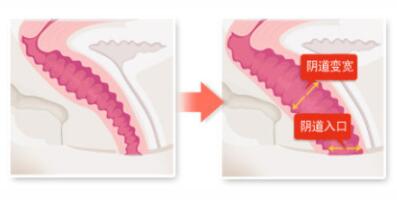 紧缩的阴道会因生育等原因变得松弛