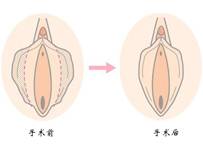 小阴唇肥大整形前后对比示意