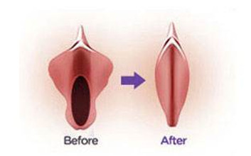 小阴唇肥大整形示意图