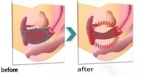 后方膣圆盖术对比示意图