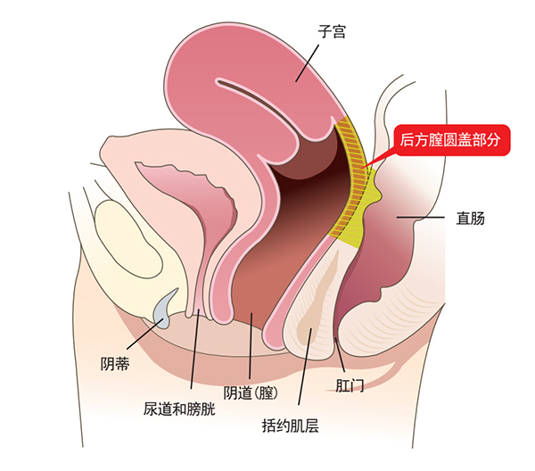 后方膣圆盖术图解