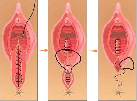 阴道紧缩缝合术