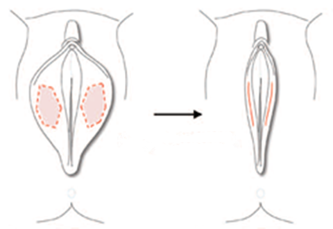 小阴唇手术前后