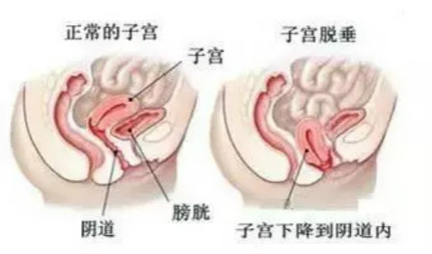 下垂的子宫示意图