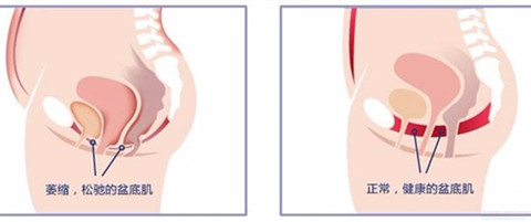 盆底肌松弛前后对比图