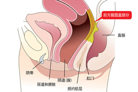 后方膣圆盖术部位介绍