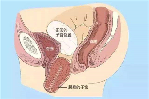 盆底功能障碍示意图