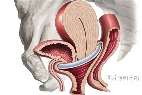 阴道壁膨出示意