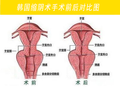 阴道紧缩术