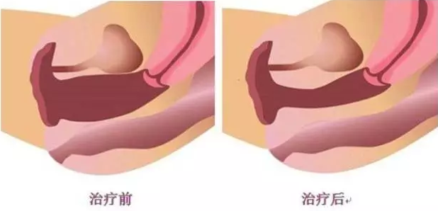 好手艺妇科私密整形手术效果对比