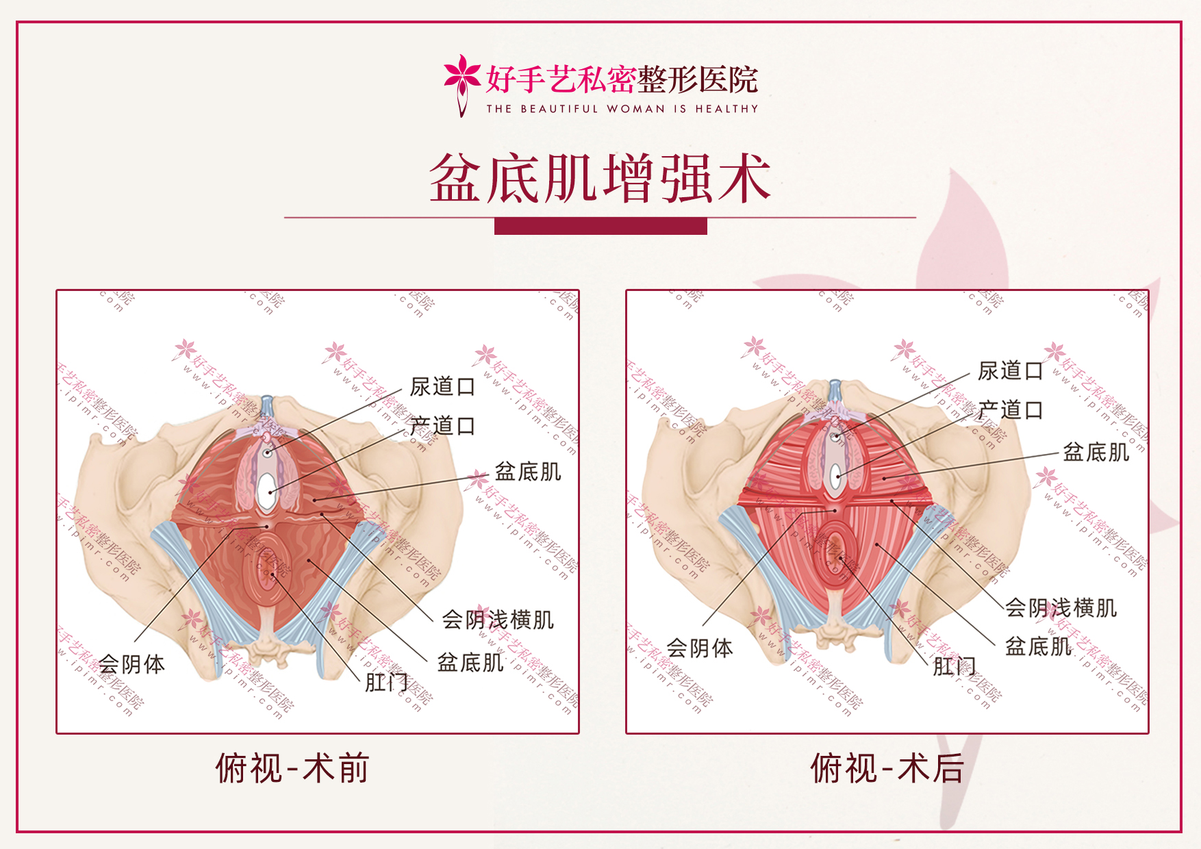 盆底肌增强术效果图